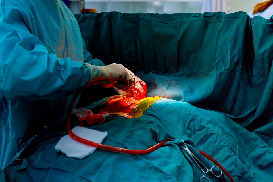 coronary-angioplasty-surgery-in-bangalore